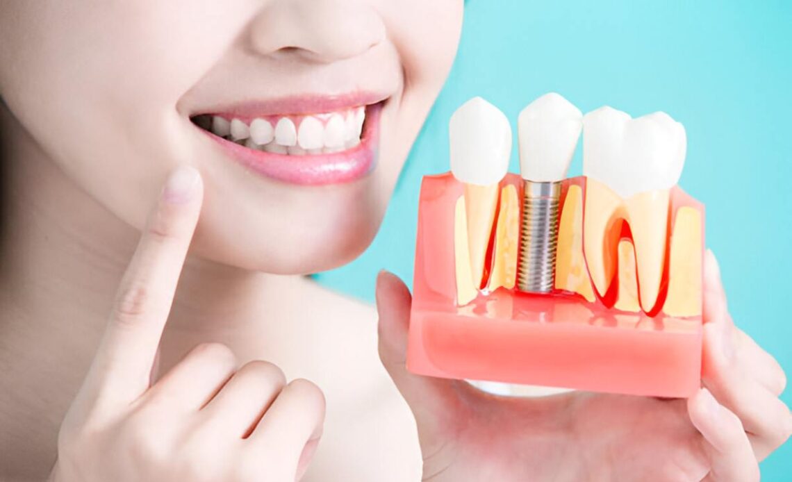 Why Dental Implants Are a Smart Choice for Missing Teeth