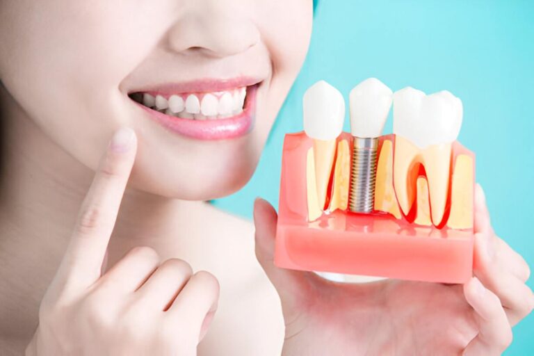 Why Dental Implants Are a Smart Choice for Missing Teeth